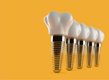 All-On 4 / All-On 6 implant
