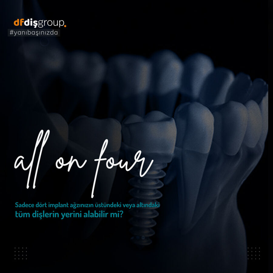 All on four — 4 implant ile tüm dişlerin yerini alan tedavi